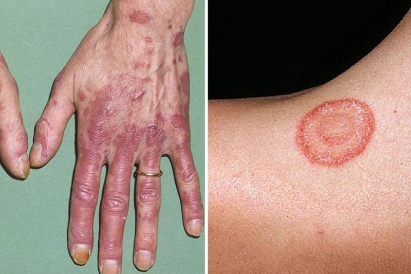 Rau má có tác dụng hỗ trợ điều trị lupus ban đỏ hệ thống