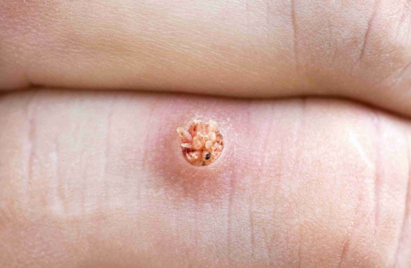 muncoclagi93466b0311 1