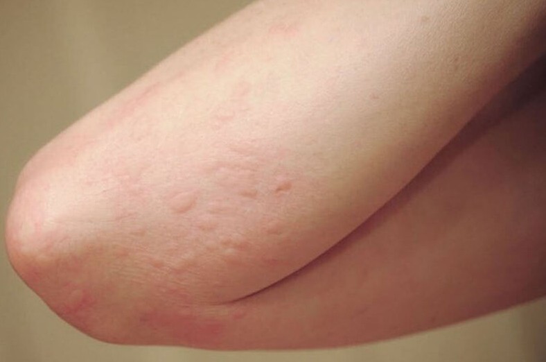 Sử dụng chanh dây quá nhiều có thể gây tác dụng phụ.